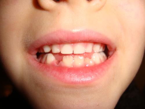  Certains ne supportent pas voir une bouche édentée... Nous, c'est plutôt avec les vampires, qu'on a un problème. 